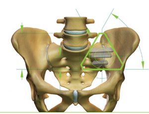 SI Joint Pain