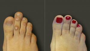 Foot & Ankle hammer toe 2