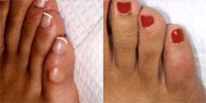 Foot & Ankle hammer toe
