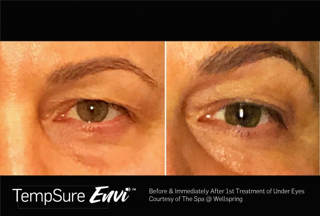 TempSure Envi Before and After Custom Image - Wellspring Updated JPEG