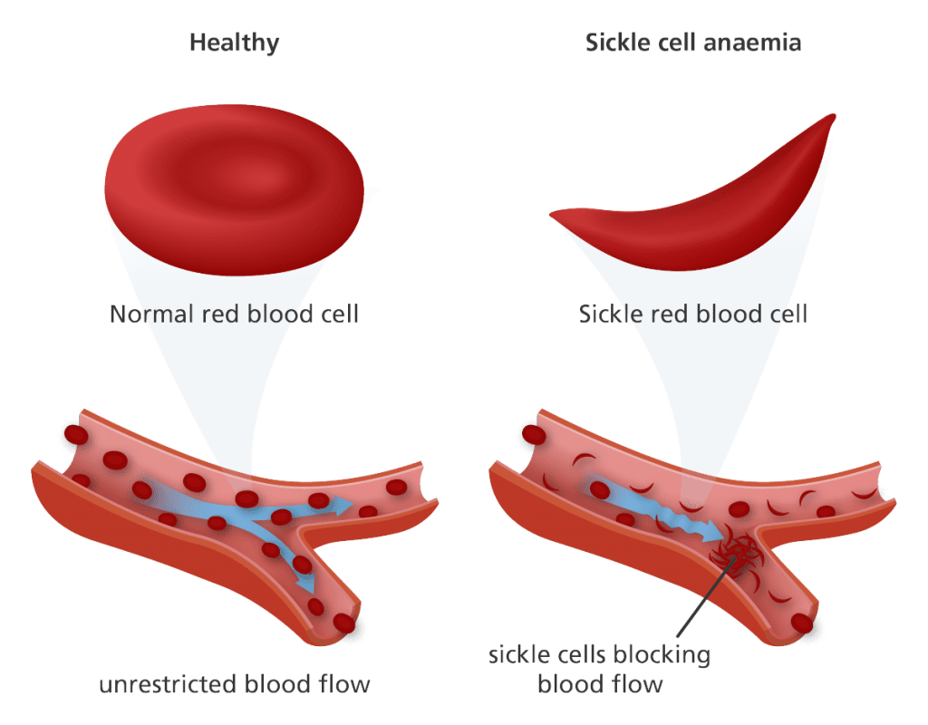 Sickle Cell Anemia